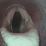 Kehlkopfpfeifer nach OP